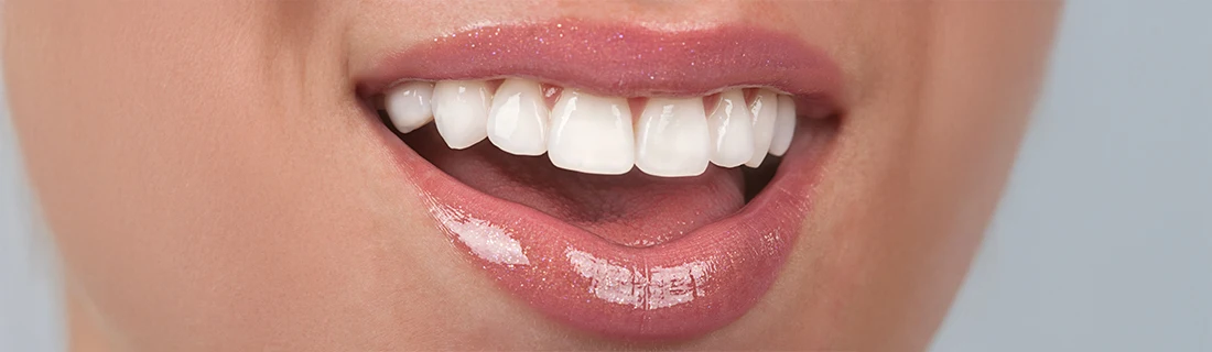 Dentist Feeding Hills MA Beautiful Huge White Full Smile Close-up of a woman's mouth showcasing a Beautiful Huge White Full Smile