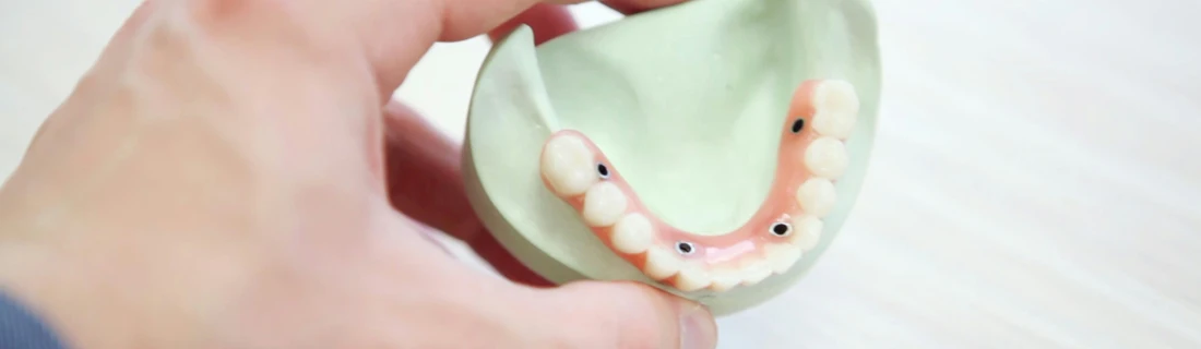 Dentist Feeding Hills MA Dentures Focused a close up detailed view of a set of partial dentures for the bottom of a mouth being held in a hand