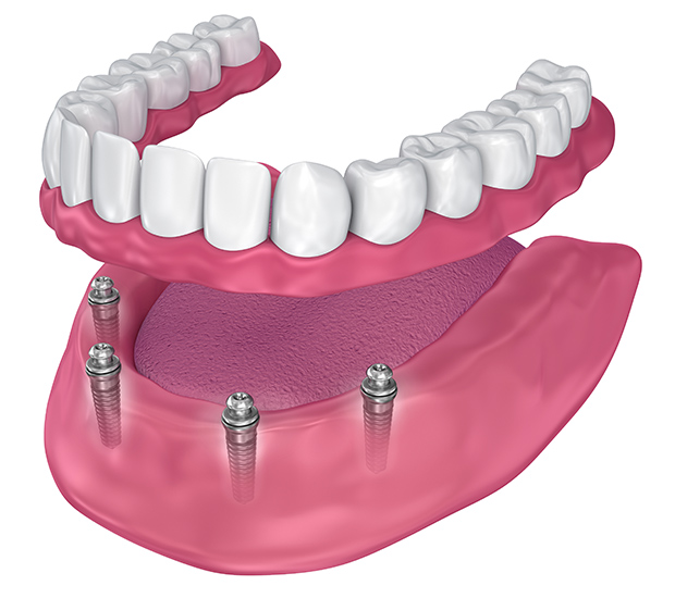 Feeding Hills All-on-4 Implants