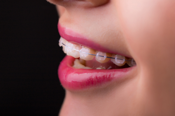 How Clear Braces Can Give You Straighter Teeth