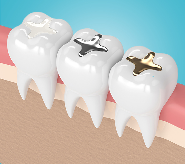 Feeding Hills Composite Fillings