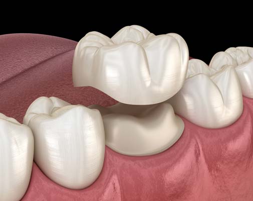 When Is A Dental Crown Necessary?