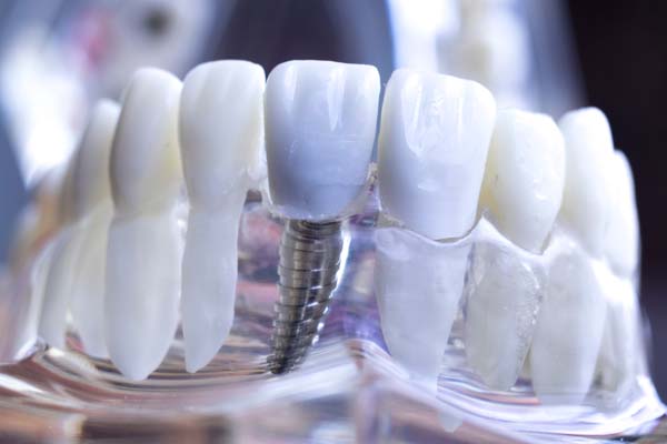 Who Is A Candidate For Dental Implants?