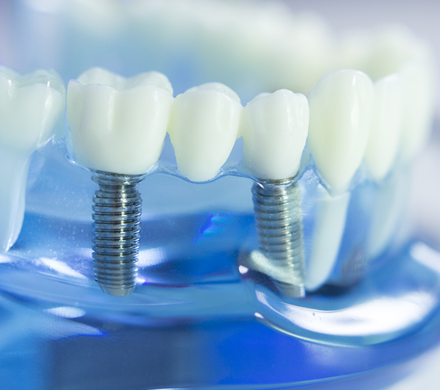 Feeding Hills Dental Implants